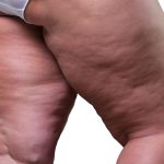 Lipedema